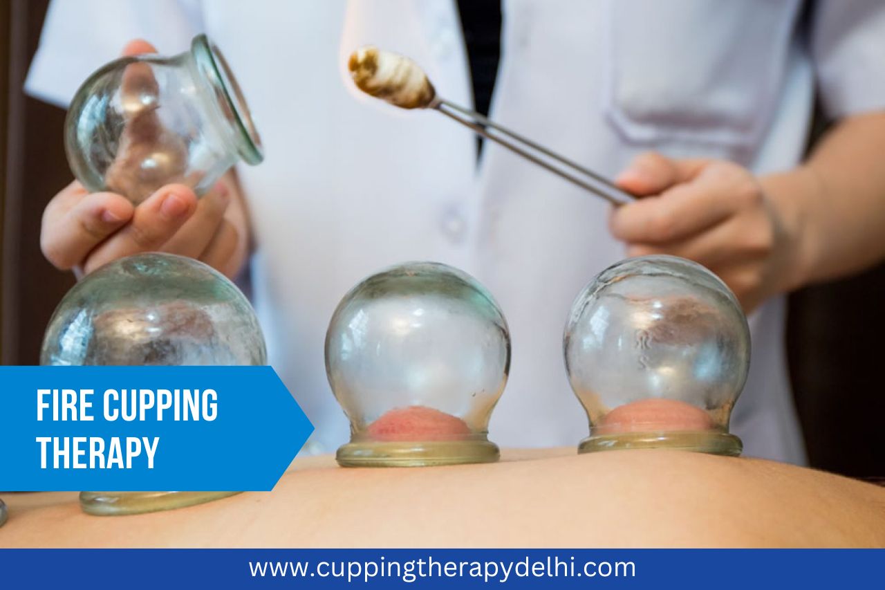 Enhancing Your Quality of Life with Cupping Therapy