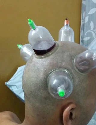 Potential of Hijama Cupping for Hair Regrowth